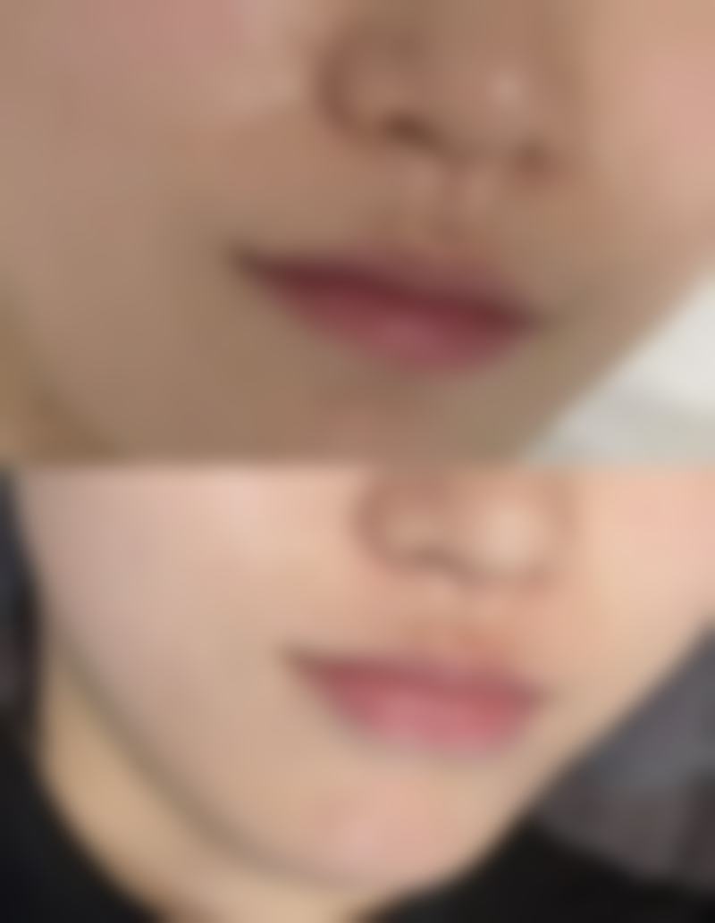 祛疤有哪些注意事项？