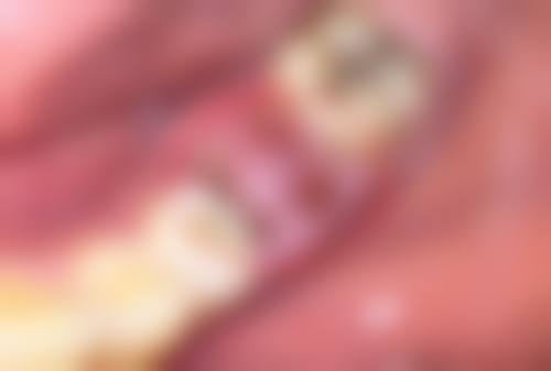 多磺酸粘多糖乳膏、复方肝素钠尿囊素凝胶、积雪苷霜软膏和人表皮生长因子凝胶分别适用于什么样的手术疤痕？