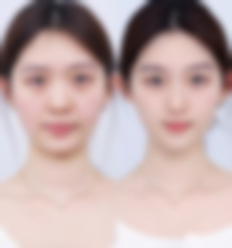 抽脂还有其他可能的危害吗？