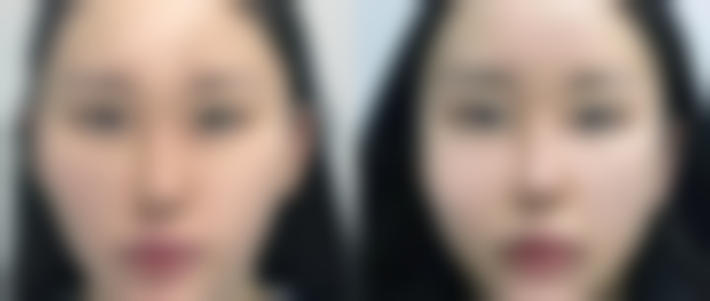 隆鼻怎么取耳软骨？取耳软骨后耳朵会变形吗、有哪些注意事项你了解吗？ 