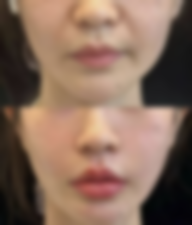 有哪些方法可以修复凸现疤痕呢?