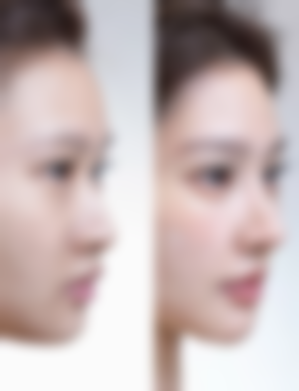 冷敷热敷对双眼皮肿眼泡有什么成效，该如何操作？