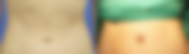 不同治疗方法对兔唇疤痕修复成效如何？