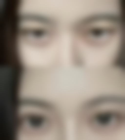 影响肋骨隆鼻拆线时间的因素有哪些呢？