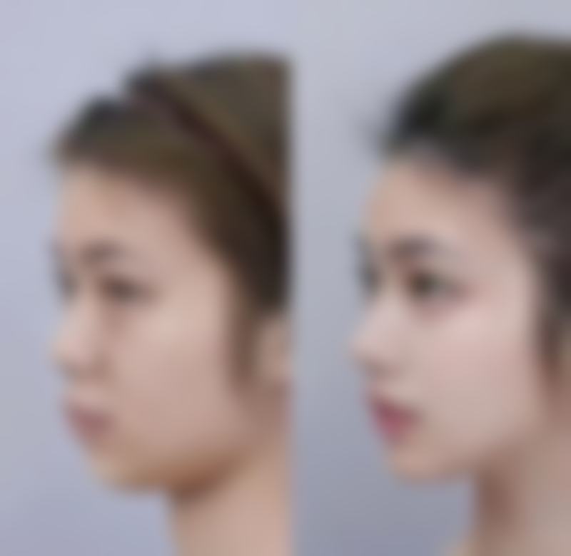 如果手术过程复杂、创伤大或者术后感染，拆线时间会怎样变化？