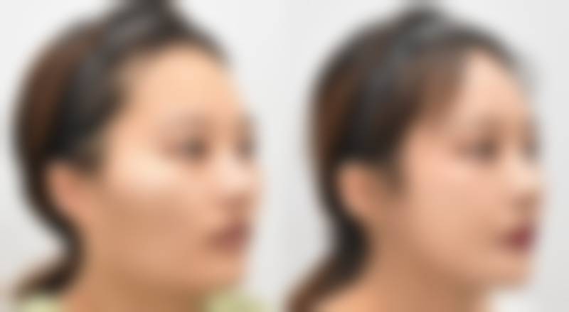 饮食和生活习惯对消肿有什么影响？