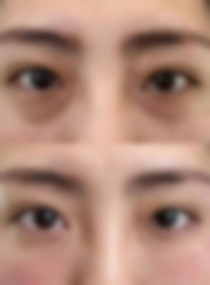 保持头部高位对消肿有什么作用？