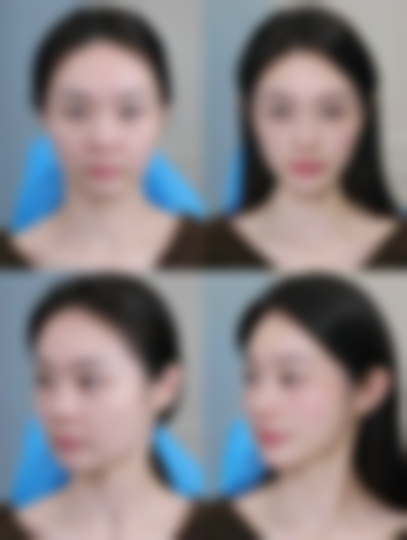 手术切除去眼袋适合什么样的眼袋？修复时间要多久？