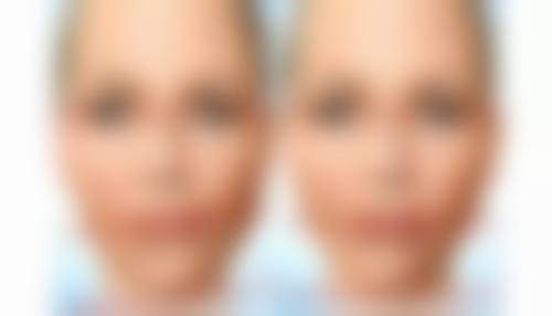 白山汉诚整形医院王殿峰医生吸脂减肥技术怎么样？