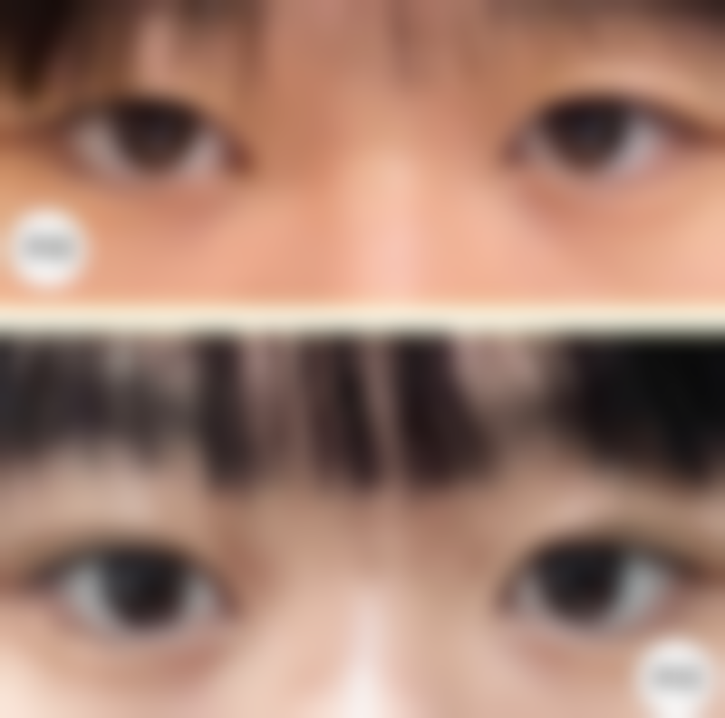 新生轻浅疤痕可以用哪些护肤品和药物？