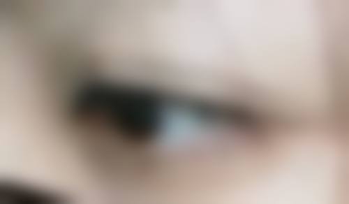 粉刺留下的疤痕怎么办?试试激光治疗、涂抹药膏，还可从日常护肤改善！ 