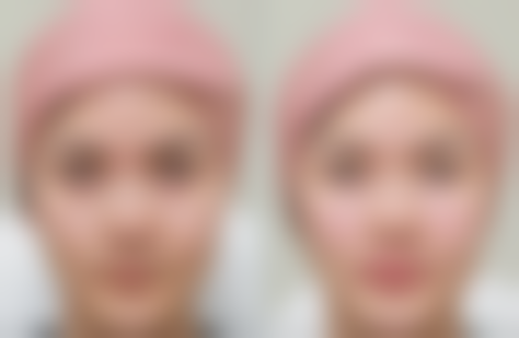 除皱针(肉毒素注射除皱)有什么优势和风险?