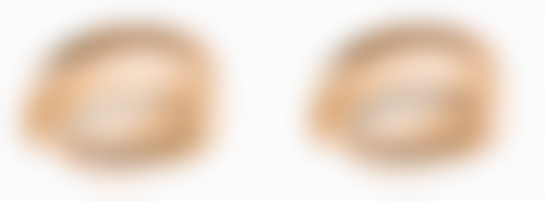 使用祛疤膏治疗旧疤痕需要注意什么?