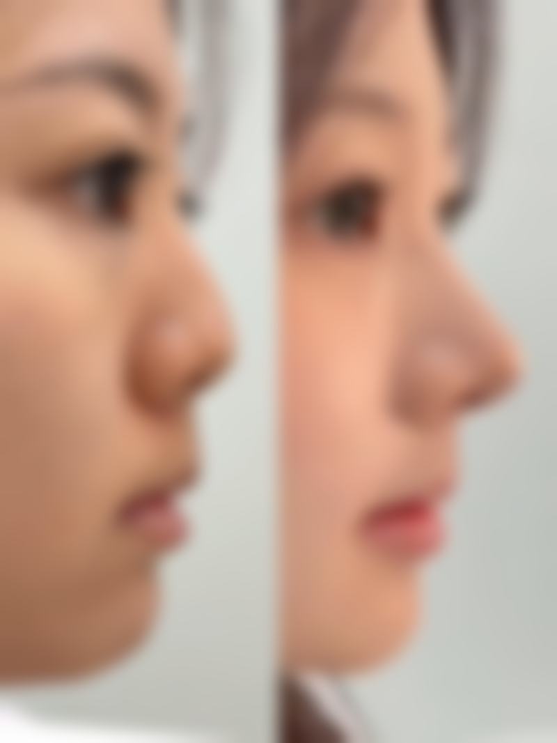 玻尿酸丰太阳穴多久打一次？一般间隔6 - 12个月，具体需看个人吸收情况！ 