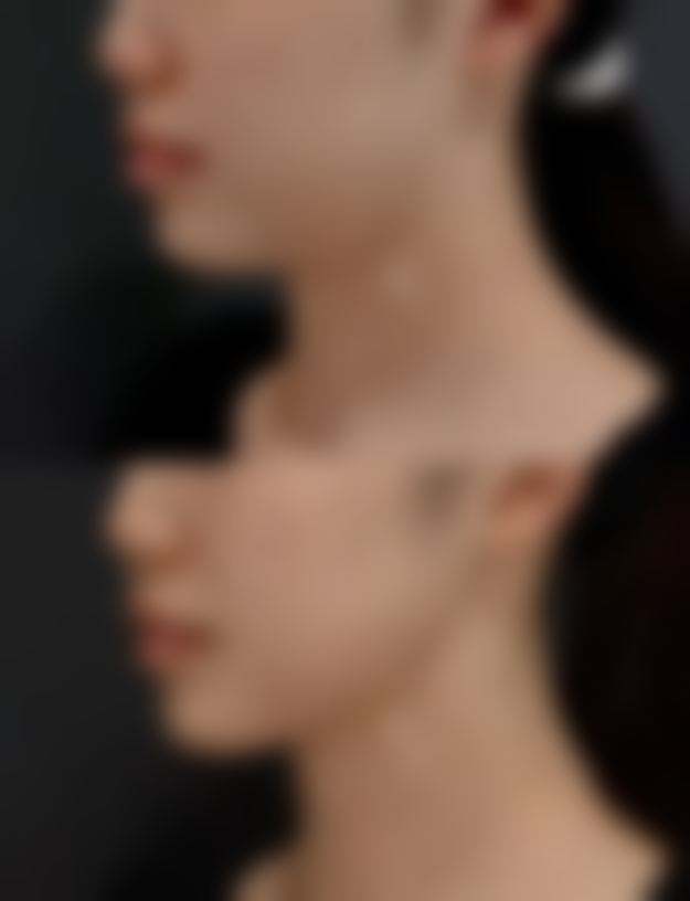 旧疤痕用什么祛疤膏？硅酮凝胶、多磺酸粘多糖乳膏或许是不错选择！ 