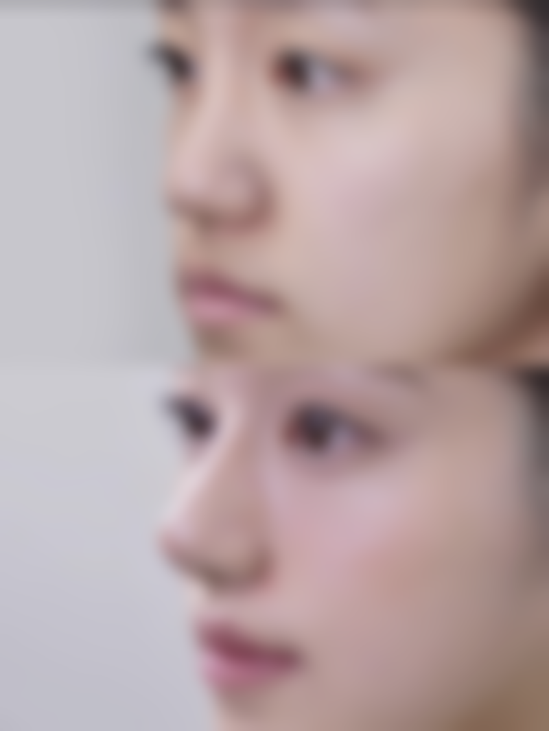 仁健FUE植发技术、仁健SUE微针植发技术、仁健WUE微针加密植发技术各有什么特点和适用场景？