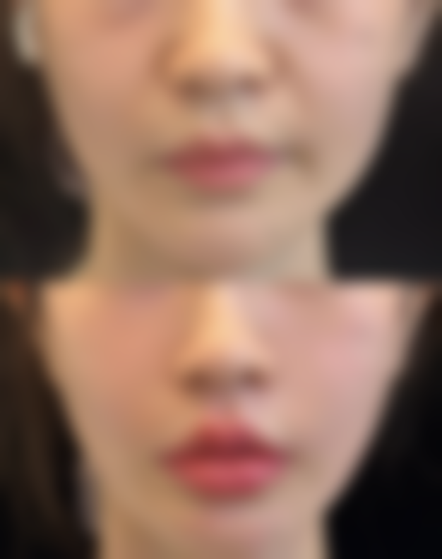 毛囊单位提取术（FUE）的适用场景和优势是什么？