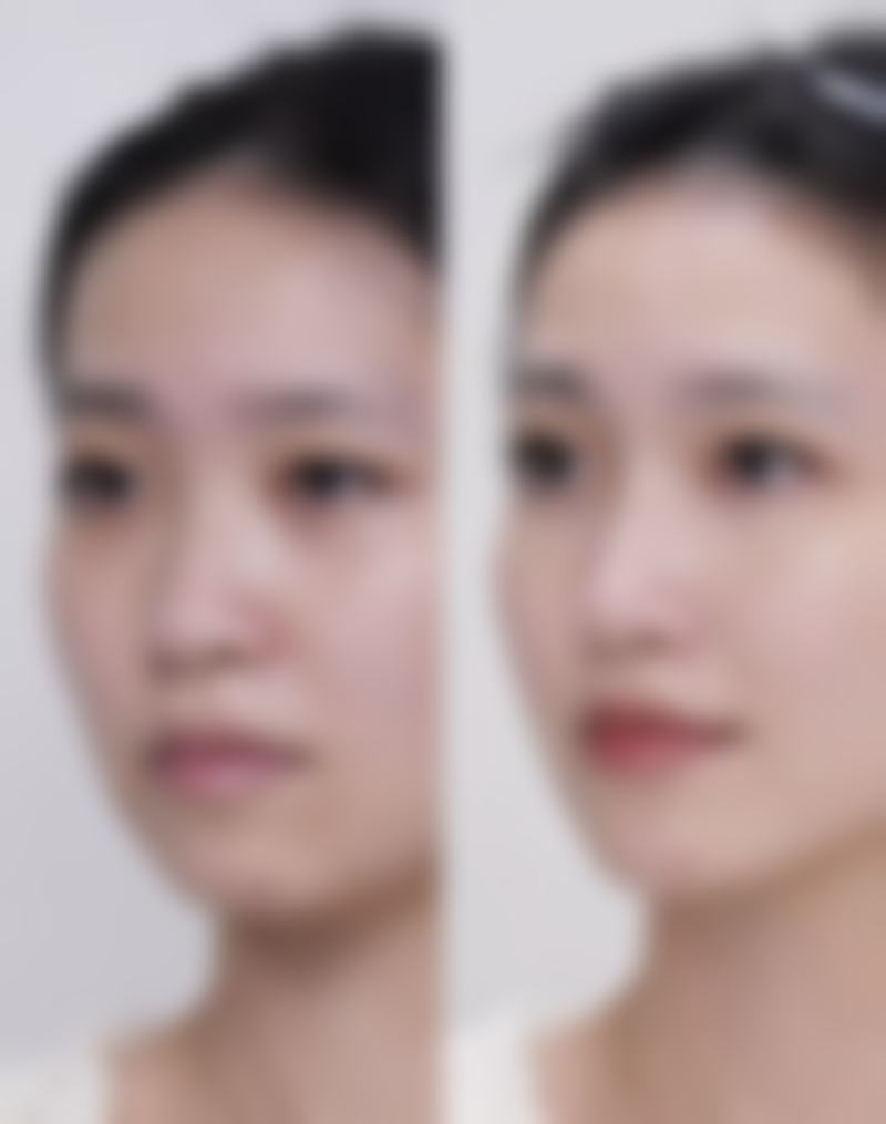 擦伤后怎么预防留疤呢？