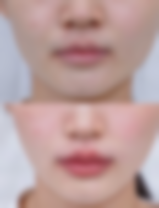 疤痕体质留下的痘印如何去除？激光治疗、药物涂抹和良好作息能否帮你摆脱痘印烦恼？ 