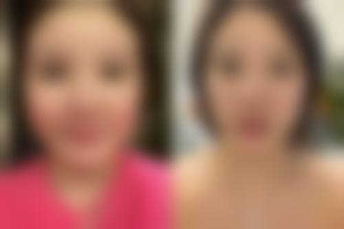 小阴唇整形术后护理要点有哪些?