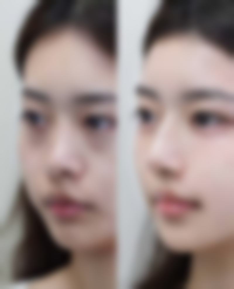 小阴唇整形手术有啥风险?