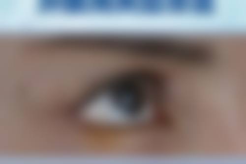 术后疤痕该如何护理和治疗?