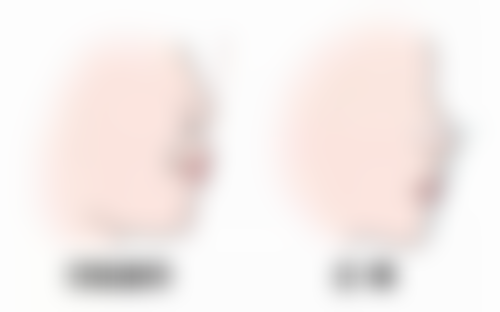 医美/手术类去眼袋有哪些方法，分别适配哪些人群？