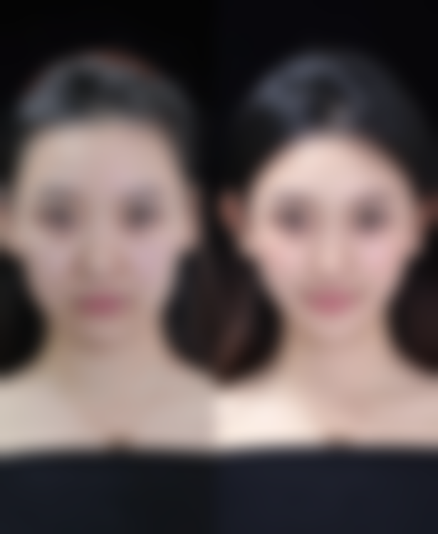 剖腹产疤痕增生怎么去除，费用和修复期大概是怎样的？