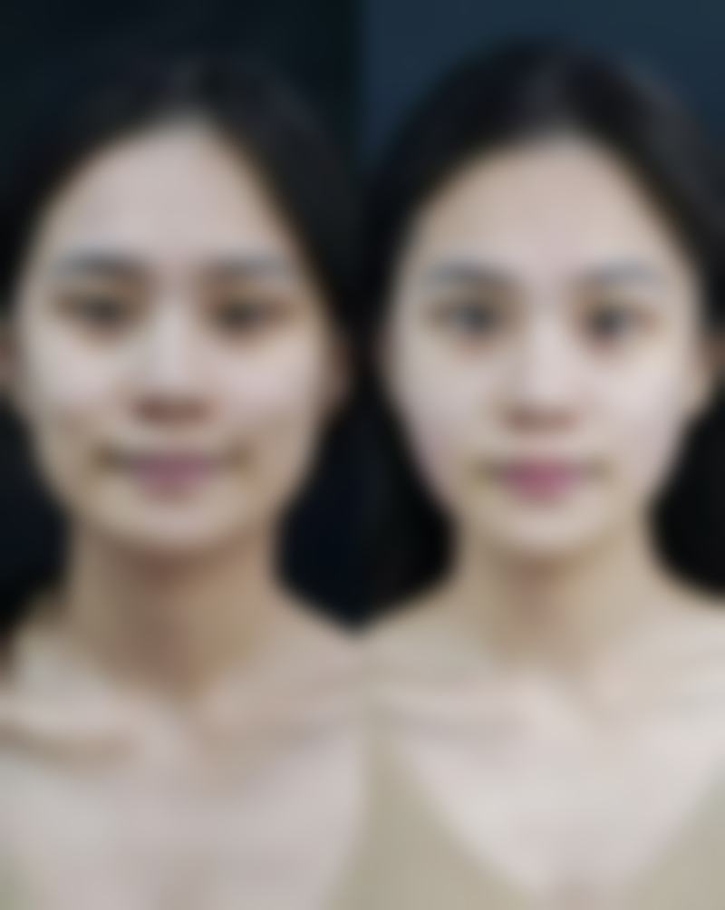 使用芦荟凝胶修复疤痕有什么注意事项?