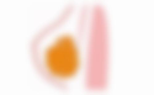 不同专精人士对M唇术后疤痕增生消退时间有哪些观点？