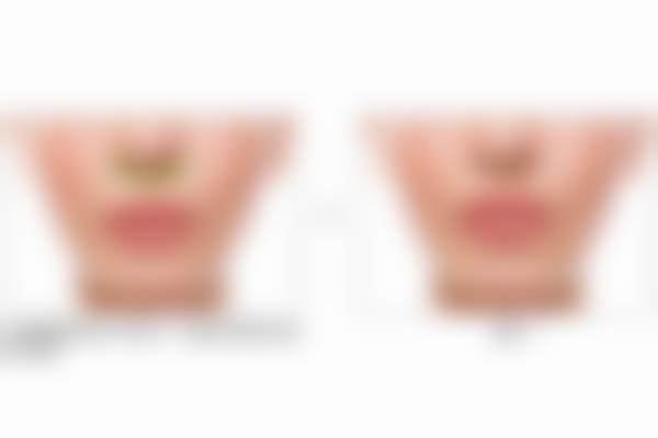 北京蕾士悦容医疗美容门诊部人中缩短术有哪些优势？