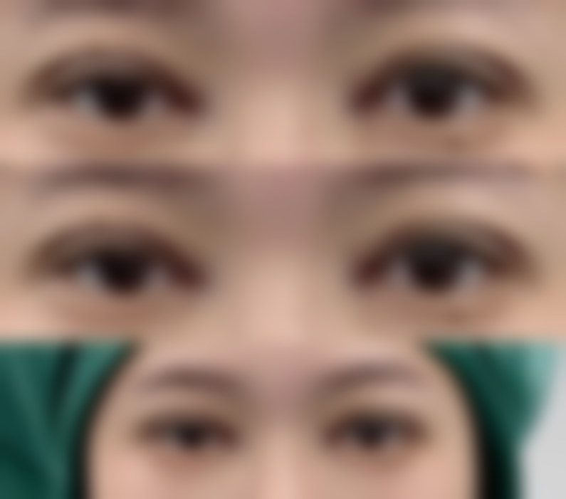 埋线双眼皮有什么特点，适合哪些人？