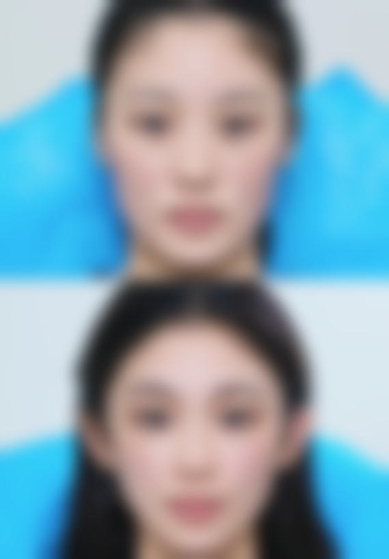 切开双眼皮（全切法）有什么特点，适合哪些人？