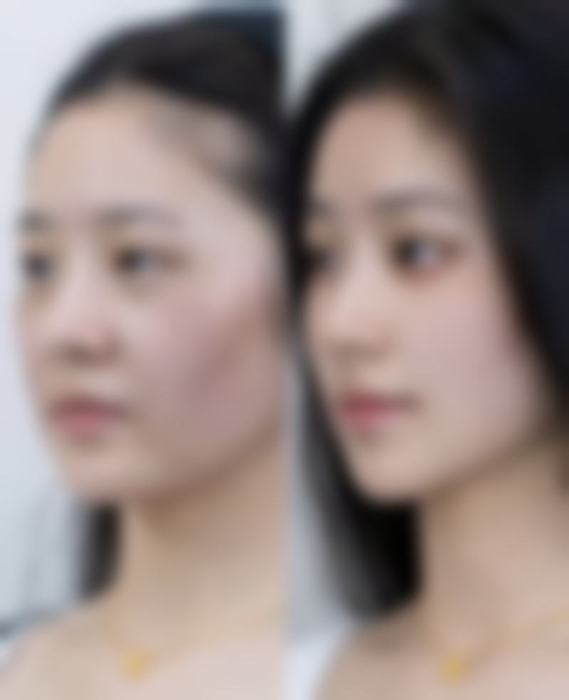 不同隆胸方式的疤痕表现如何？