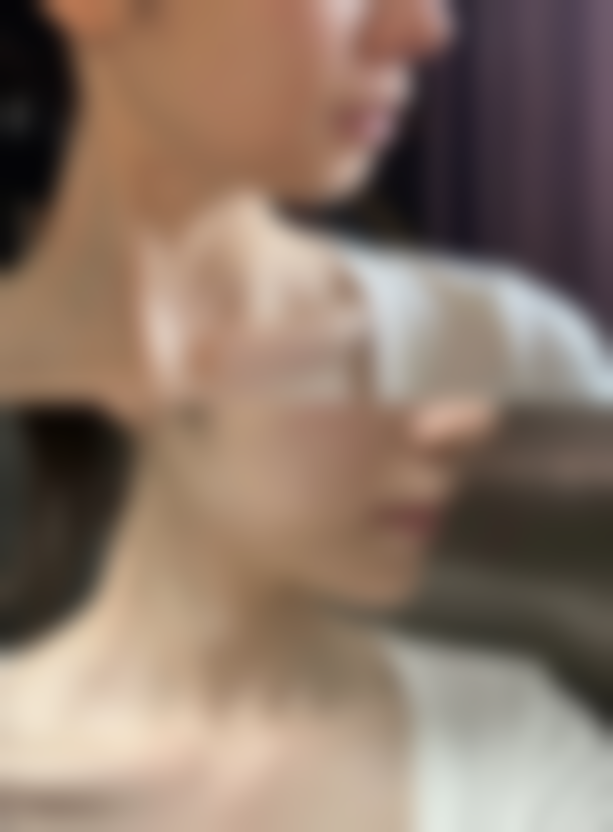 一厘米的疤痕可以完全去除吗？先进医美技术助力，多数情况有望实现完全去除！ 