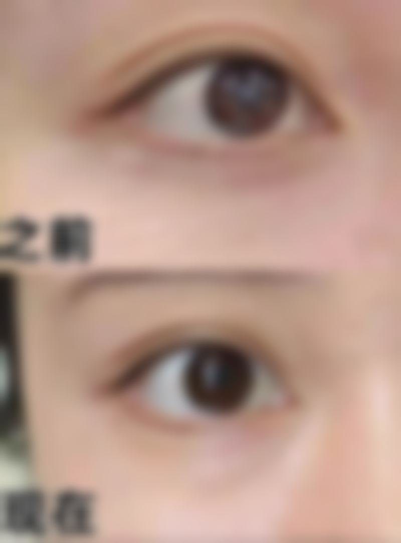 1cm的陈旧性疤痕该怎么改善？