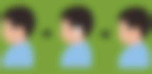 未满18岁在哪些特殊例外情况下可以割双眼皮？