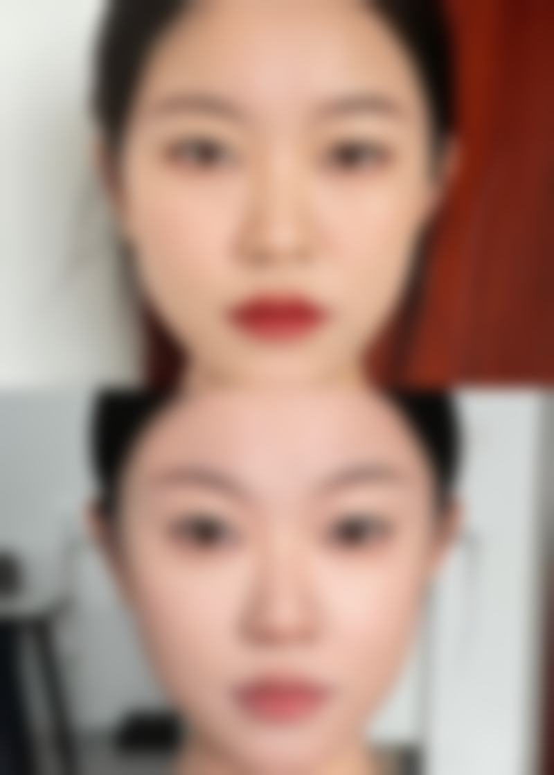 没满十八岁可以割双眼皮吗？需考虑眼部发育、心理成熟度及家长意见！ 