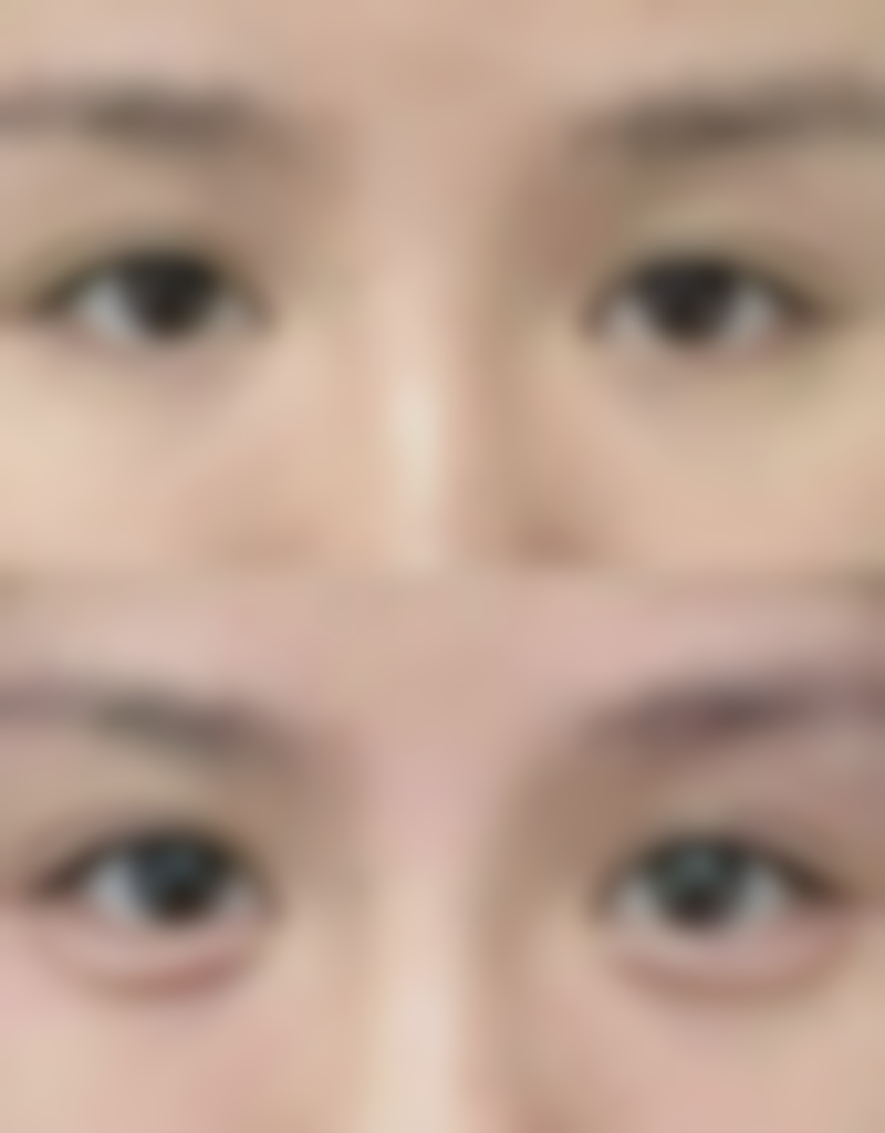 适合割双眼皮的年龄参考是怎样的？