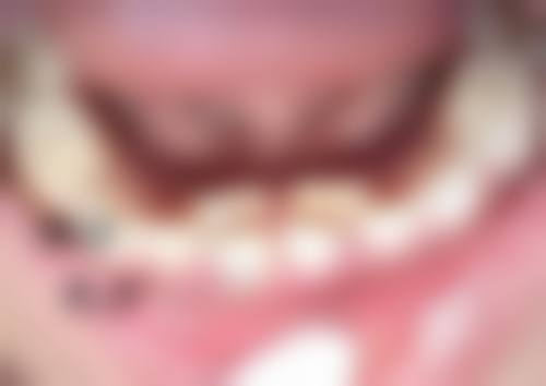 眼部吸脂手术会导致眼部功能异常、肢体活动障碍或感觉缺失吗？