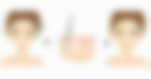 术前选择相同型号假体但本身胸部不对称导致的两边不对称怎么处理？