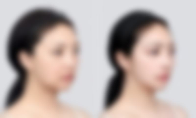 眼部吸脂手术会导致视力模糊或角膜损伤吗？