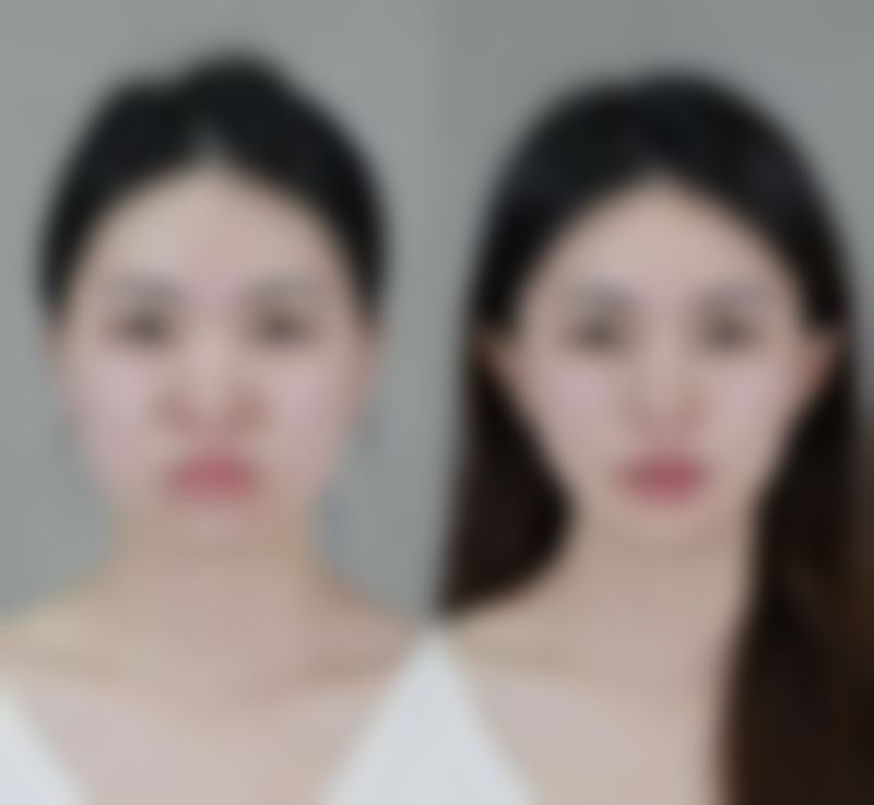 眼部吸脂手术会出现伤口血流不止的情况吗？