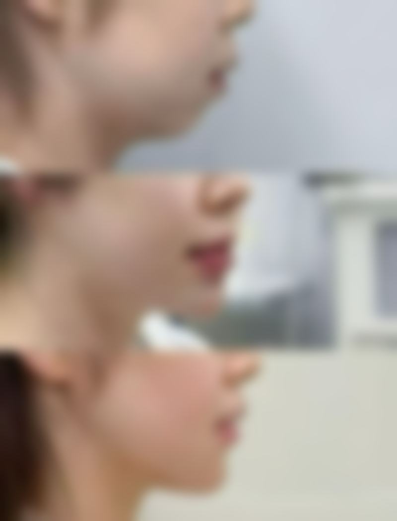 眼部吸脂手术会导致眼窝凹陷吗？