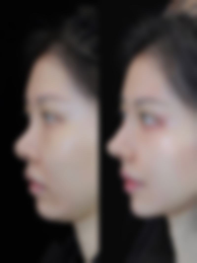 五十多岁做双眼皮有什么风险吗？