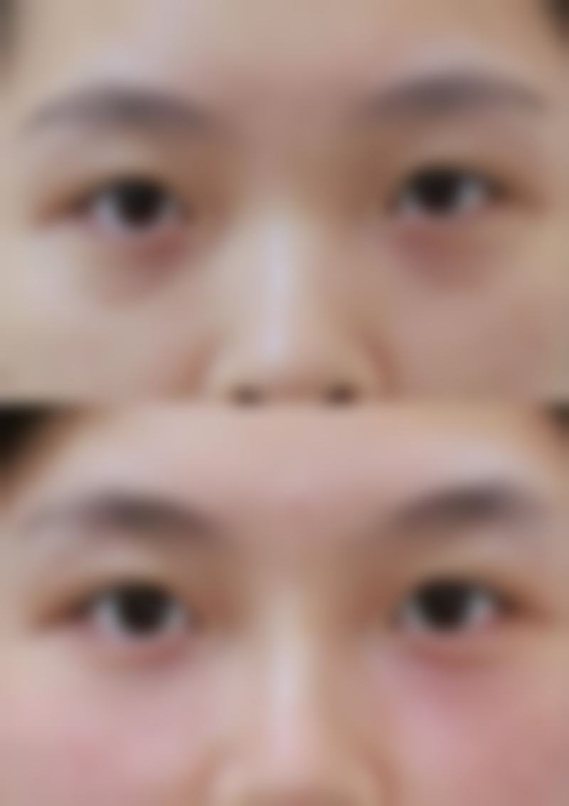 手术难度上，腰腹环吸和腰腹抽脂有什么不同？