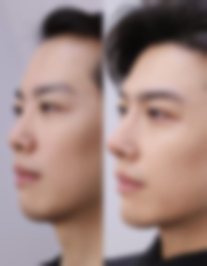 打完瘦脸针后会不会反弹？做好这些护理，让你长久保持精致小脸不反弹！ 