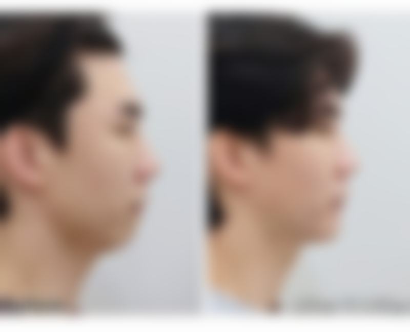 修复手术的流程是怎样的？