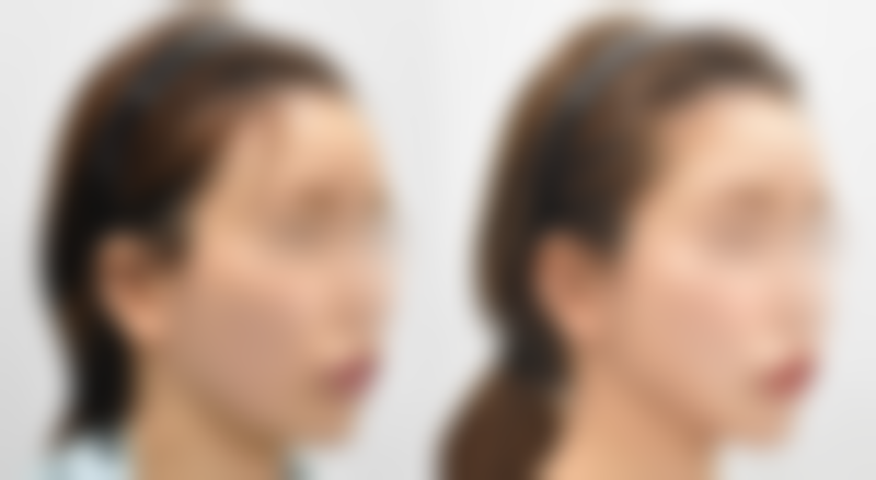 不同术式的抽脂法眼袋术各有什么特点和风险?