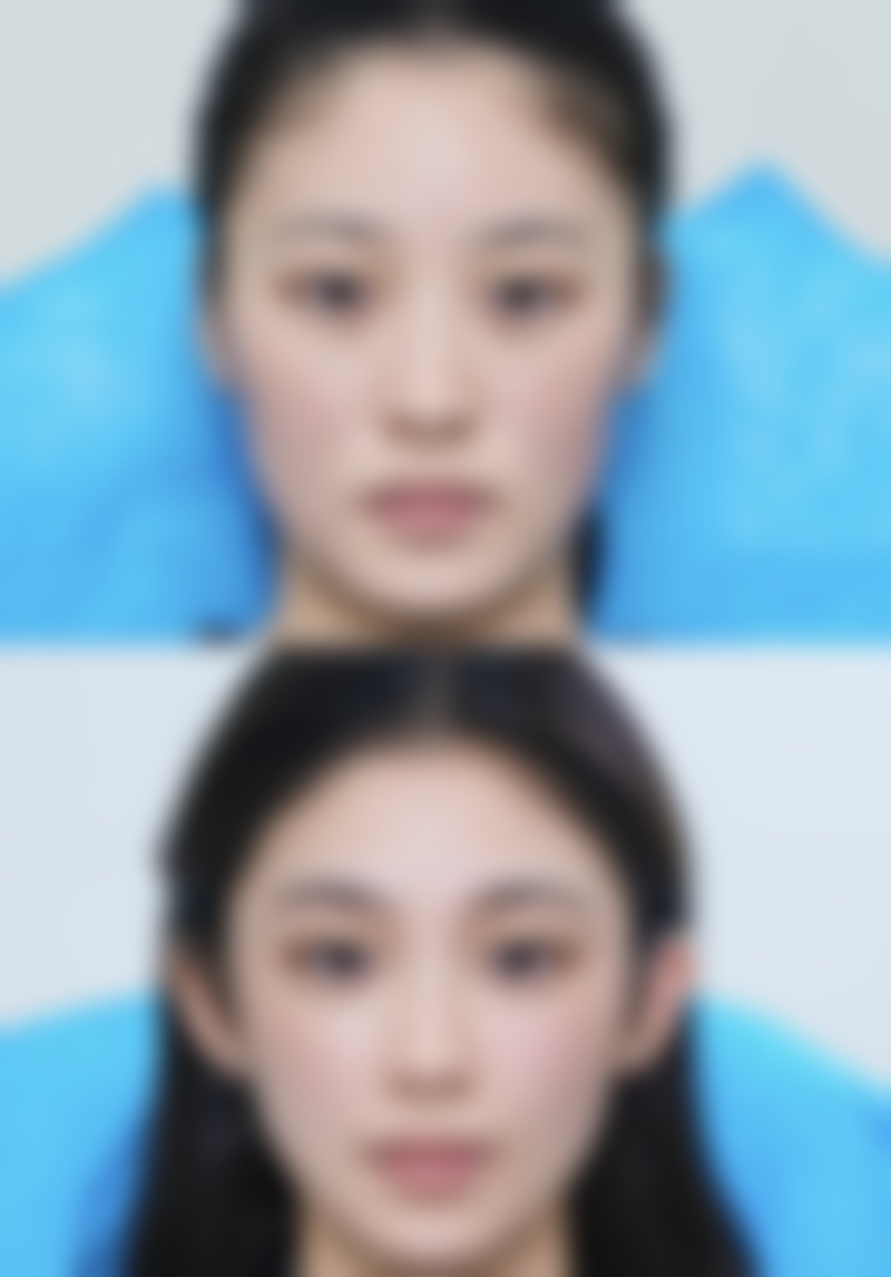 双眼皮过宽的常见诱因有哪些？